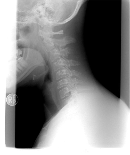 2. Jak se projevuje nevolnost od krční páteře a jak ji diagnostikovat