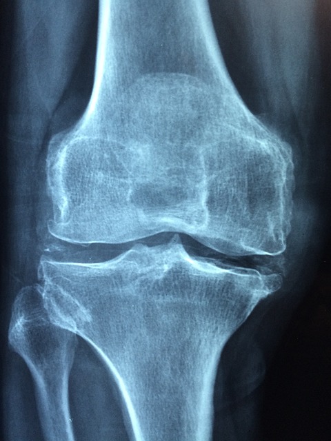 Cviky proti artroze kolene: Jak zvládnout chronickou bolest?